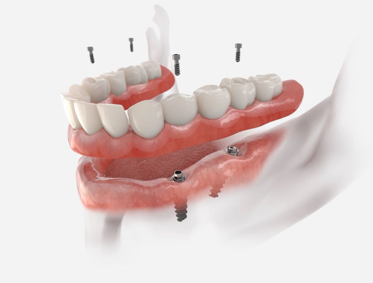 3D render of a denture supported by dental implants