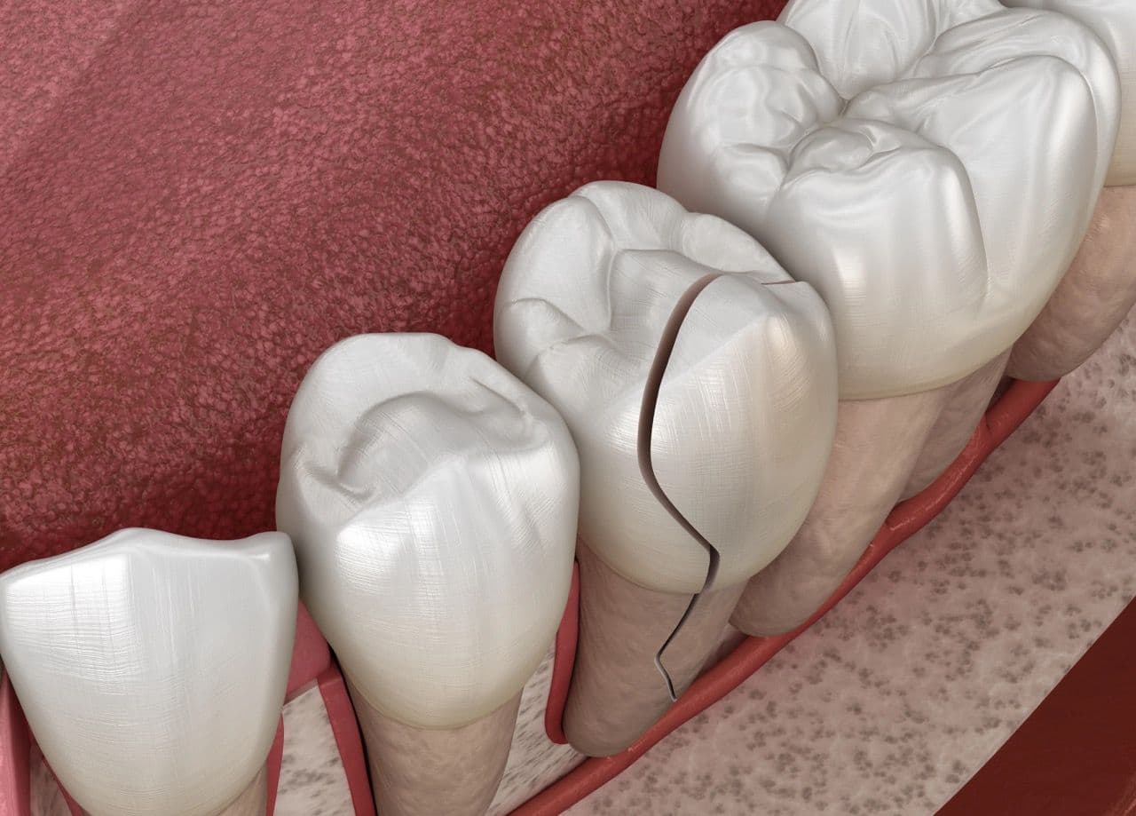3D illustration of an open mouth with a cracked tooth.