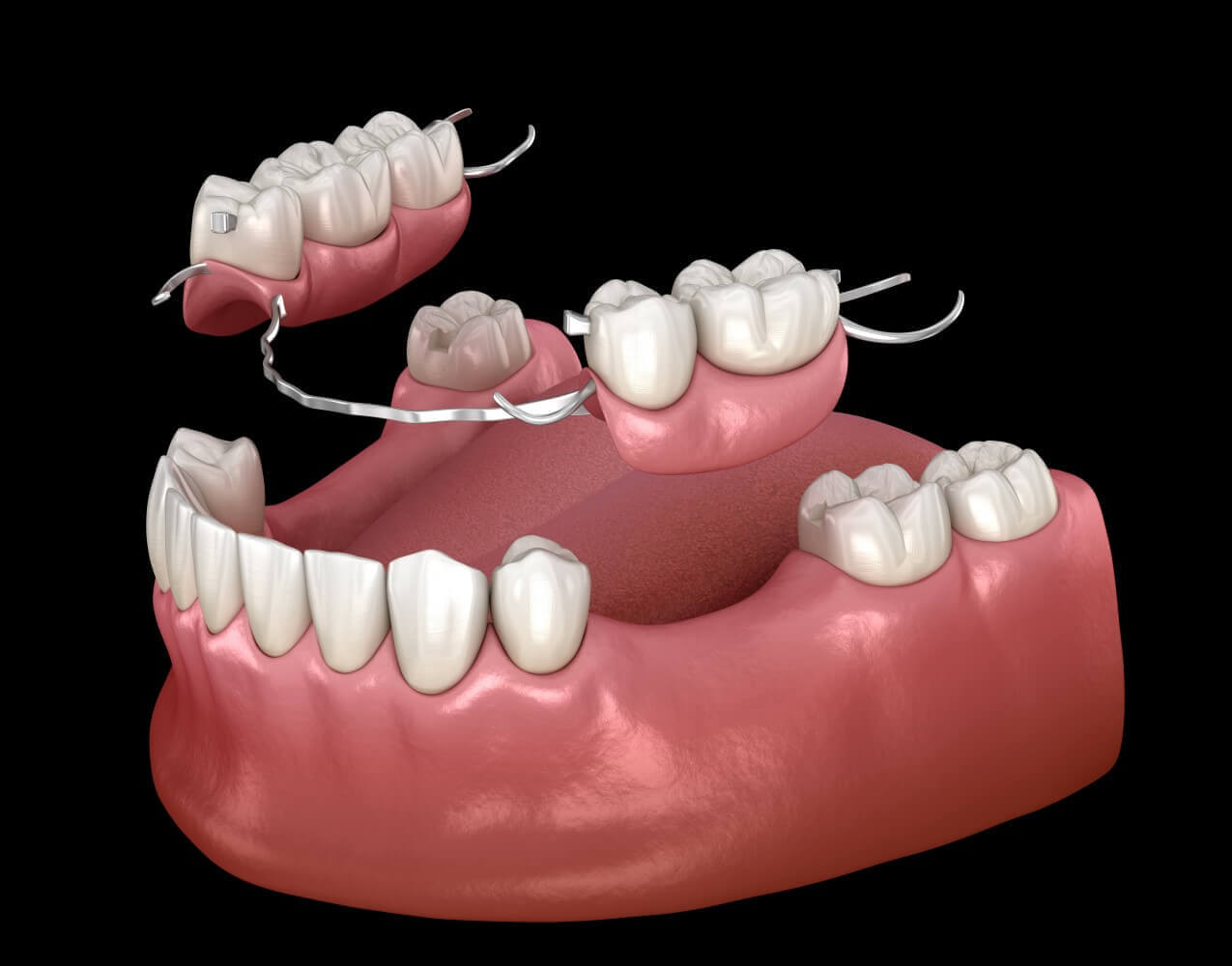 Partial Dentures for Back Teeth  