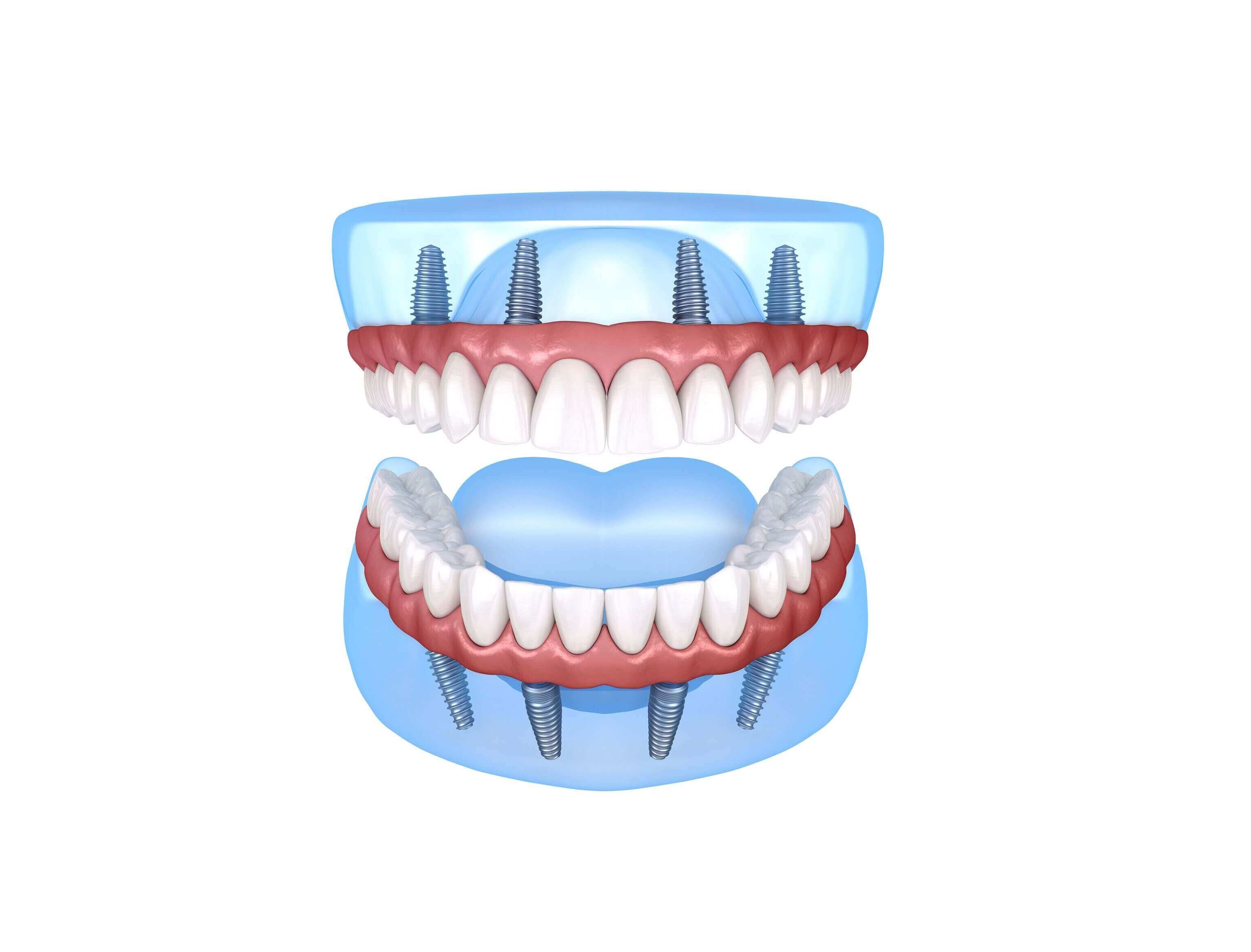 Snap-On Dentures Vs. All-on-Four Dental Implants | Affordable Dentures ...