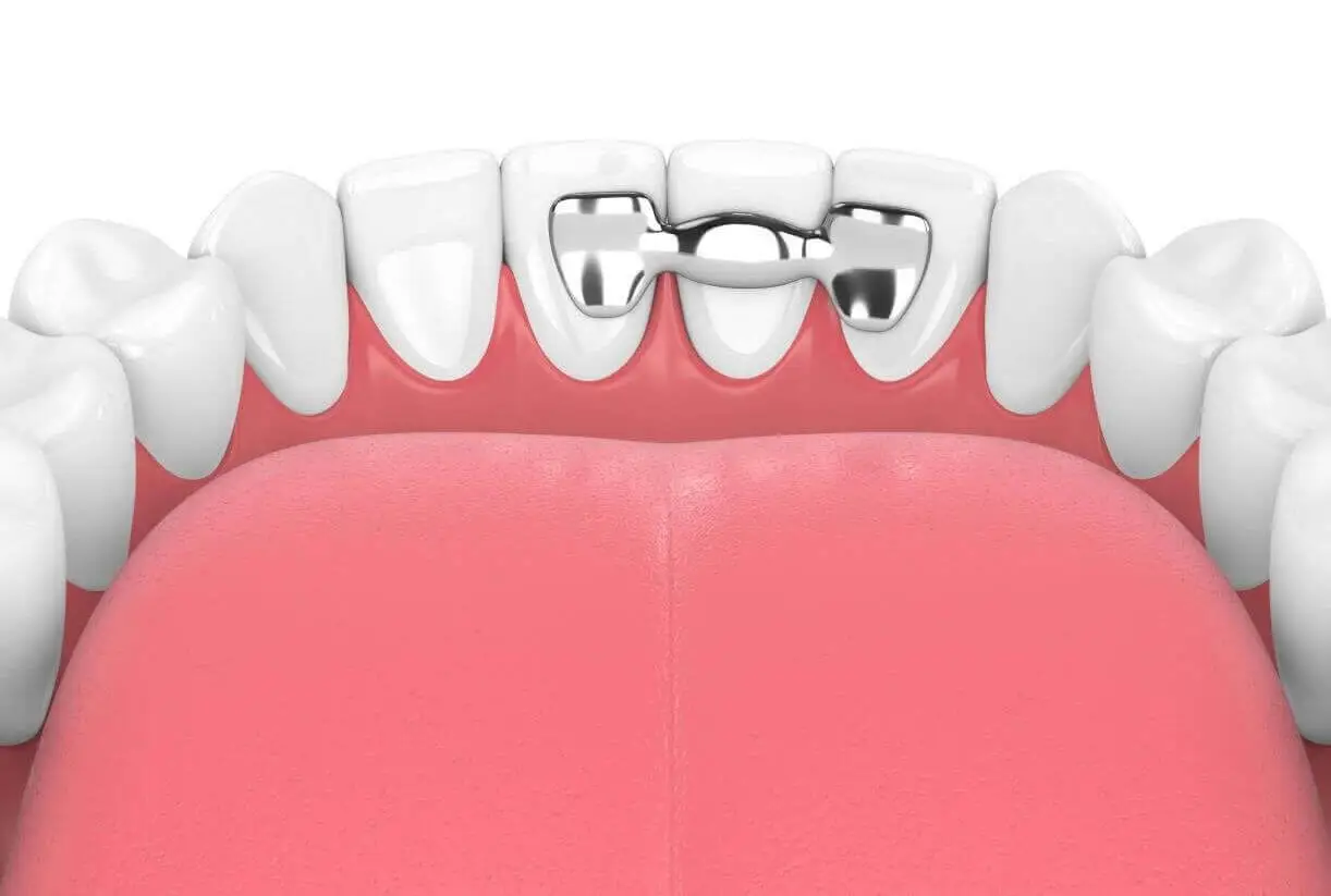 Dental Bridge Guide: Types, Uses & Costs | Affordable Dentures & Implants